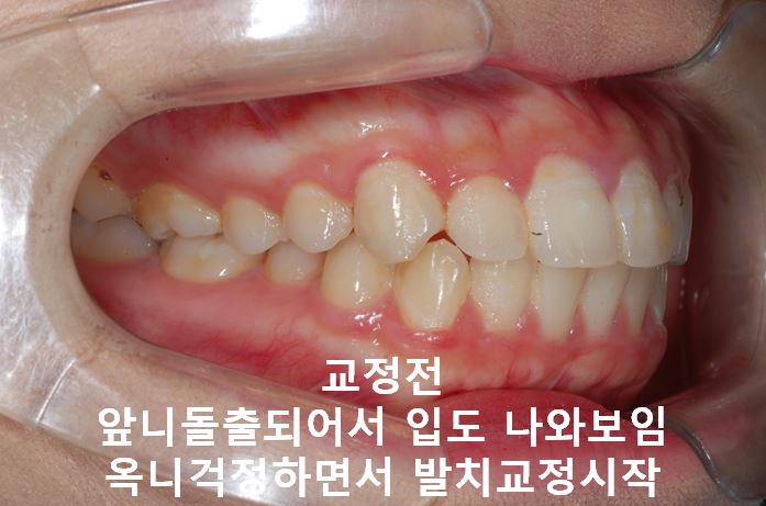 강남역돌출입교정, 옥니방지비법!! 관련 이미지 1