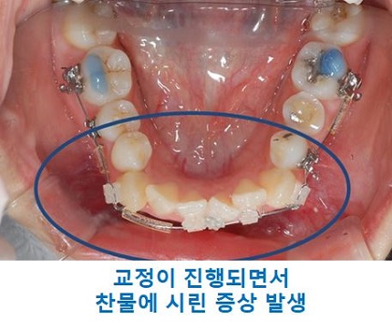교정시작을 망설이게 하는 치아교정통증(1) 관련 이미지 12