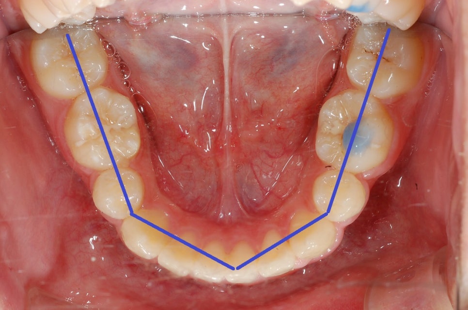 덧니방치하면 비대칭발생가능! 관련 이미지 6