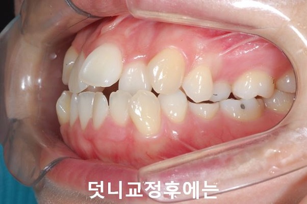 덧니교정 조심할것 3가지 관련 이미지 9