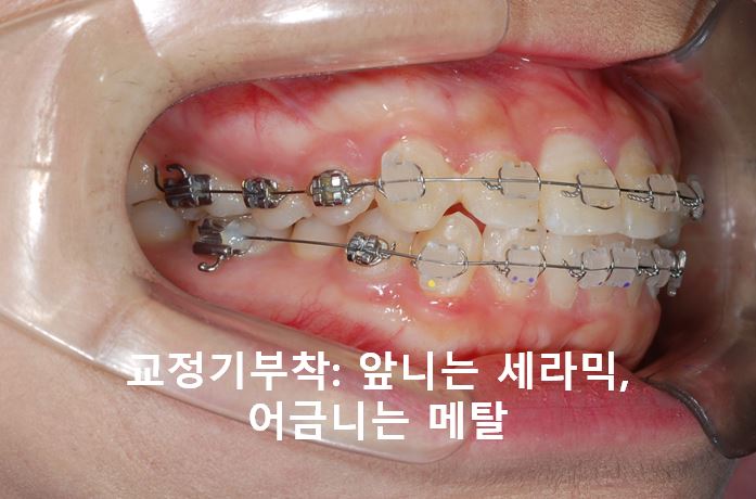 강남역돌출입교정, 옥니방지비법!! 관련 이미지 2