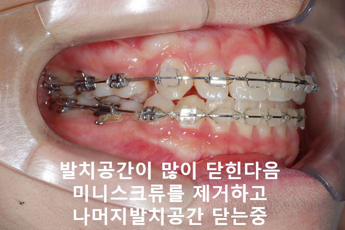 강남역돌출입교정, 옥니방지비법!! 관련 이미지 6