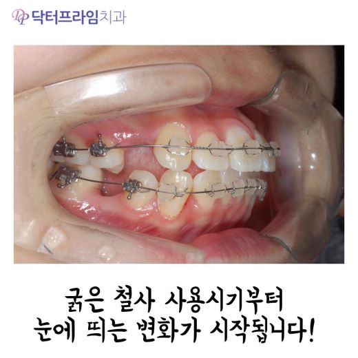 잇몸돌출교정 방법, 사진으로 보는 교정 방법! 관련 이미지 5