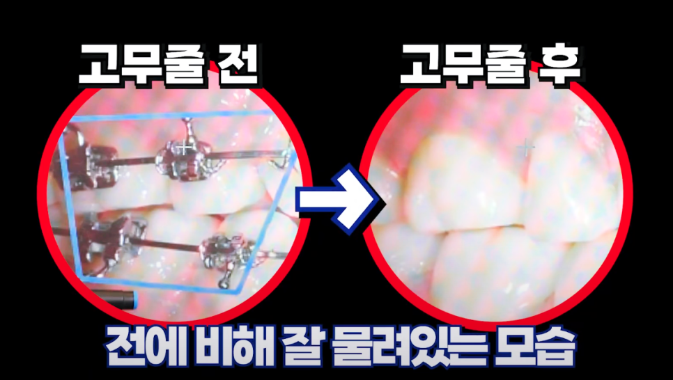 교정 고무줄, 그냥 끼는 게 아닙니다! 위치&middot;시간&middot;지속이 핵심입니다. 관련 이미지 6