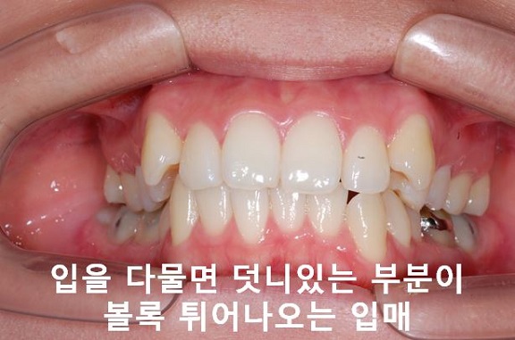 덧니교정이 곧 입매교정! 관련 이미지 9