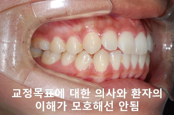 대학생 돌출입교정 망하지 않는 법! 관련 이미지 3