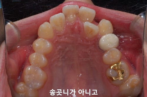 덧니교정과정, 4가지 요점만 알고 시작하세요! 관련 이미지 9