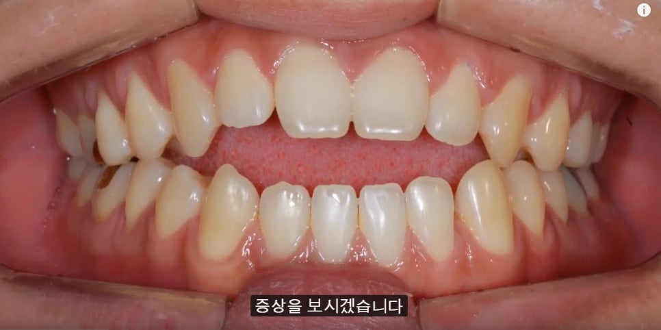 [치아교정] 개방교합의 증상, 원인,교정방법(앞니개방교합) 관련 이미지 3