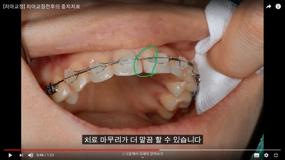 [치아교정]  치아교정전에 반드시 충치치료를 해야 하는가? 관련 이미지 2