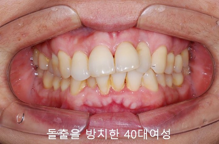 치아교정) 유지장치는 평생 해야 한다? 관련 이미지 10