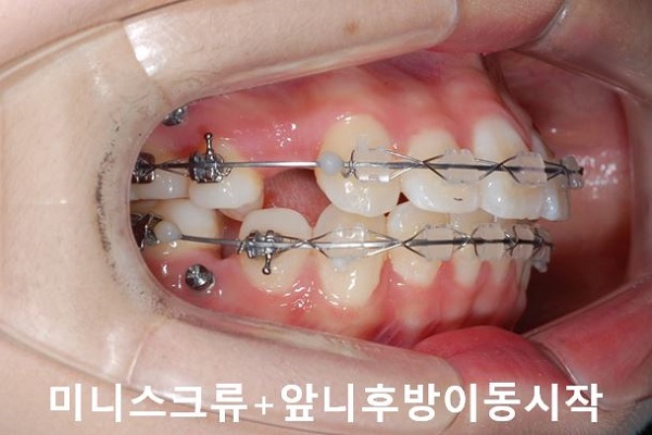 튀어나온입 교정과정 4단계요약 관련 이미지 5