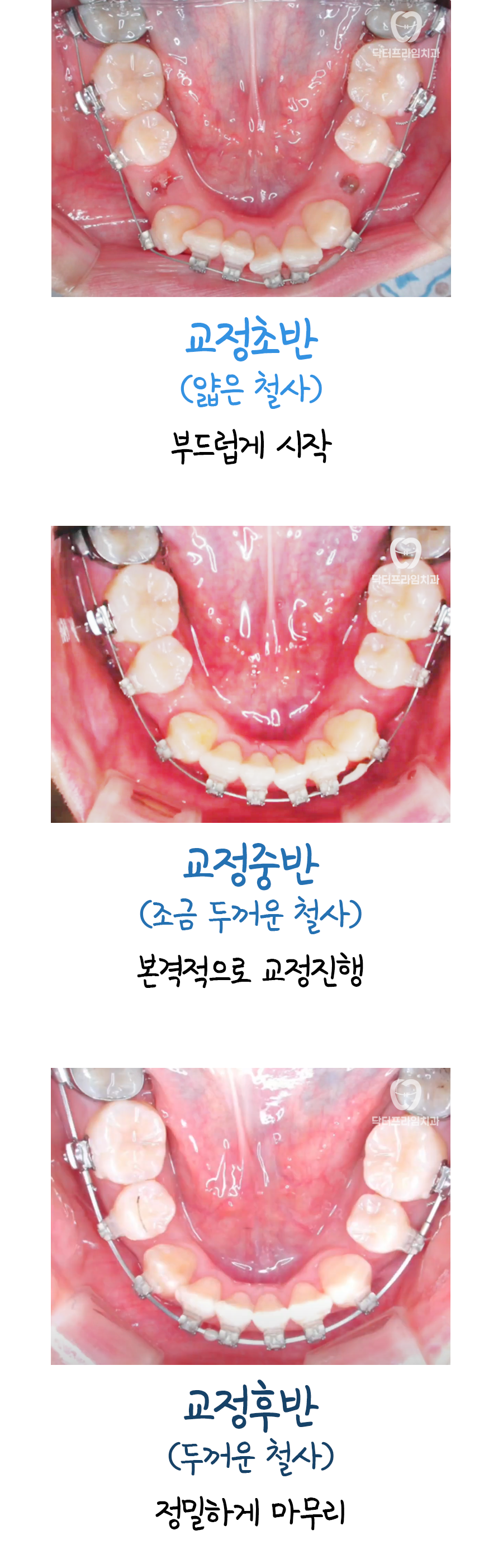 Gangnam Station Orthodontics: Why Do They Keep Changing the Wire? image 4