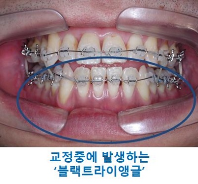 교정시작을 망설이게 하는 치아교정통증(1) 관련 이미지 14