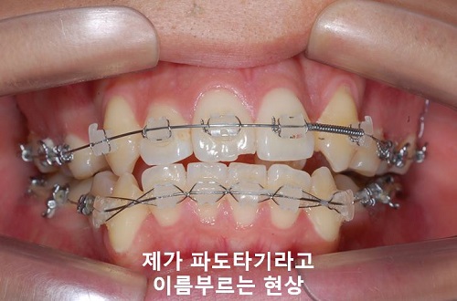 덧니교정과정, 4가지 요점만 알고 시작하세요! 관련 이미지 17
