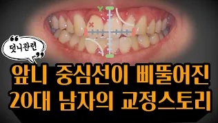 앞니교정사례 관련 이미지 1