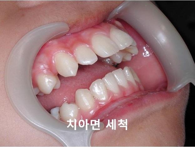 [교정기부착] 돌출입교정할때 교정기부착하는 법! 관련 이미지 3