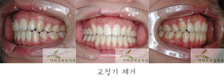 [치아교정후기] 30대 돌출입교정전후와 후기 관련 이미지 5