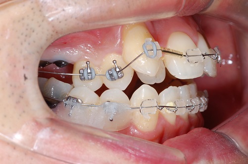 치아교정불편사항과 대처방법! (교정기에 달린 고리) 관련 이미지 11