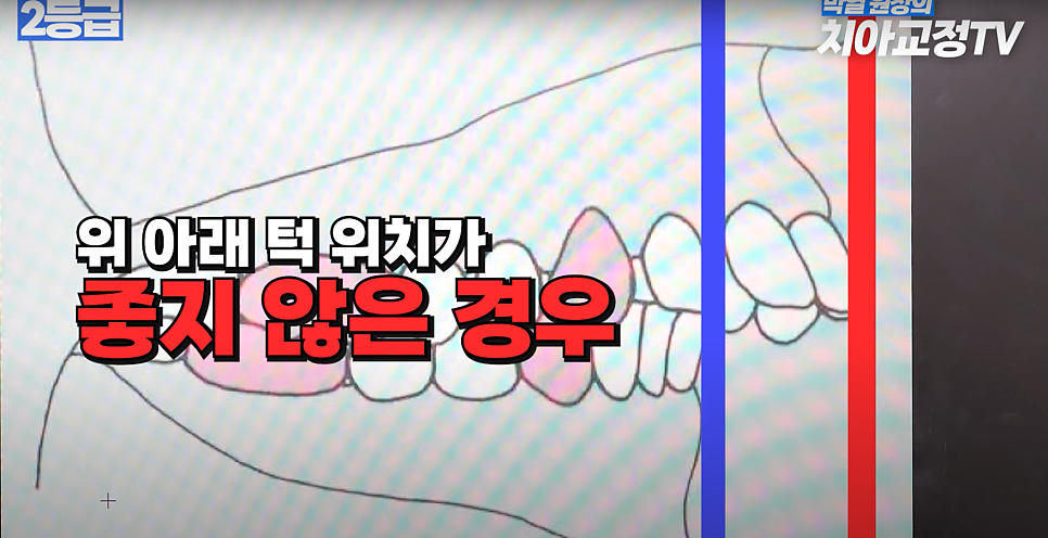 예뻐지는 교정 ? 미용 교정 후 예뻐지는 조건 & 등급 총정리! 관련 이미지 6