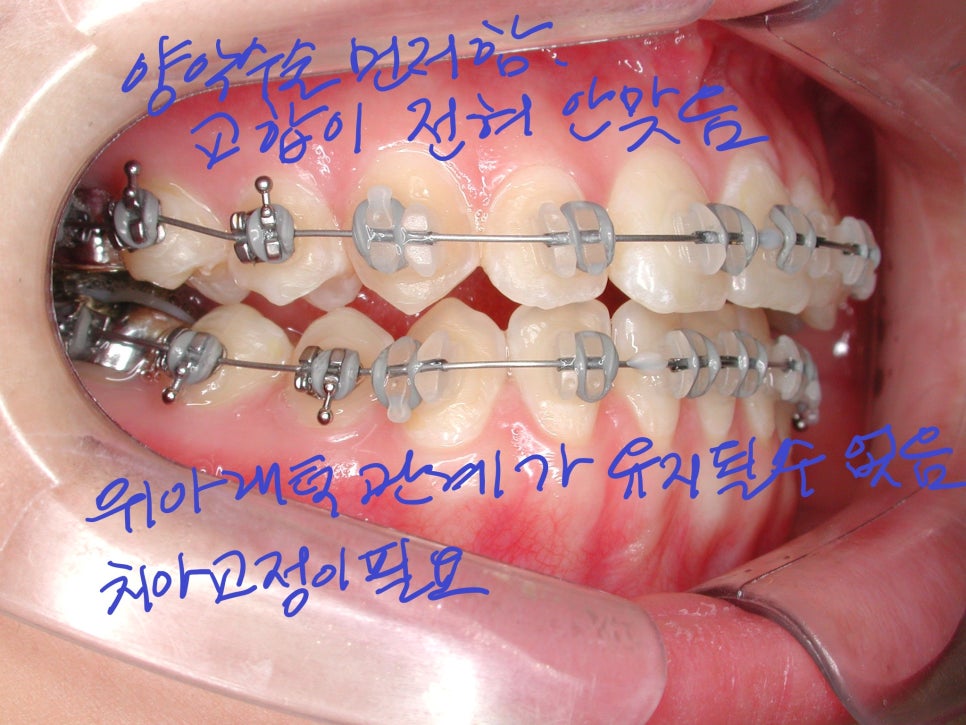 [치아교정] 양악수술방법. 선수술(=후교정)과 선교정(=후수술) 어느것이 더 좋을까? 관련 이미지 7