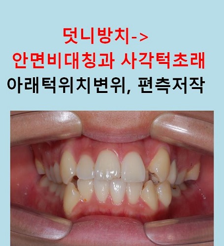 교정만으로 개선가능한 안면비대칭 알아보기(닥터프라임치과) 관련 이미지 10