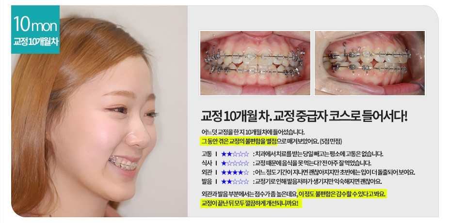 [돌출입교정전후] 앞니돌출교정사례 관련 이미지 4