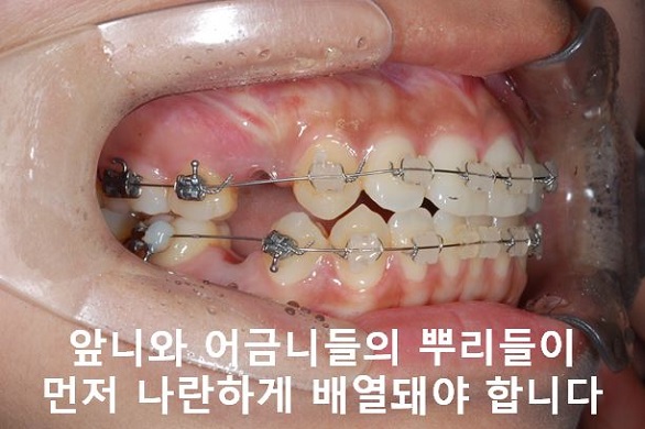 대학생 돌출입교정 망하지 않는 법! 관련 이미지 5