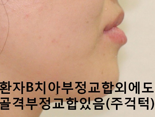 덧니와 주걱턱이 같이 있는 경우에 가장 효과적인 교정방법! 관련 이미지 9