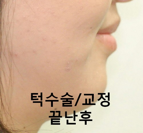 덧니와 주걱턱이 같이 있는 경우에 가장 효과적인 교정방법! 관련 이미지 15