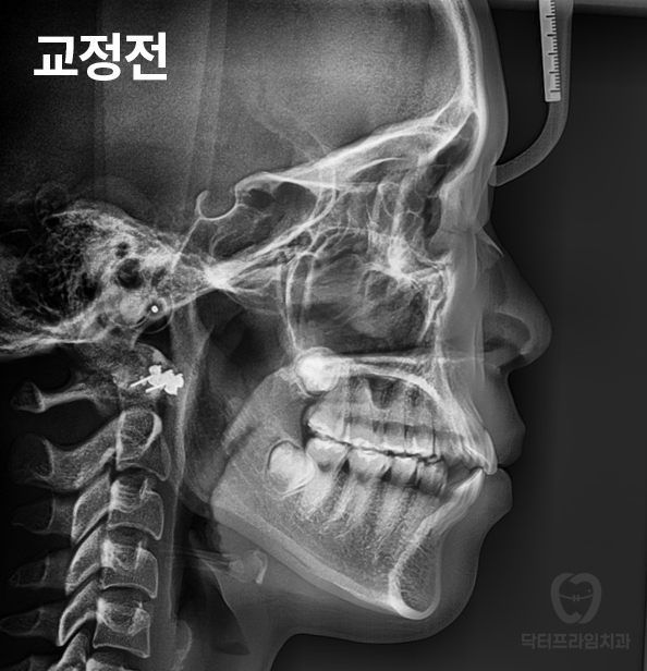 강남역 교정치과, 돌출입 발치교정하면 합죽해진다? 그렇습니다. 사실입니다 관련 이미지 11