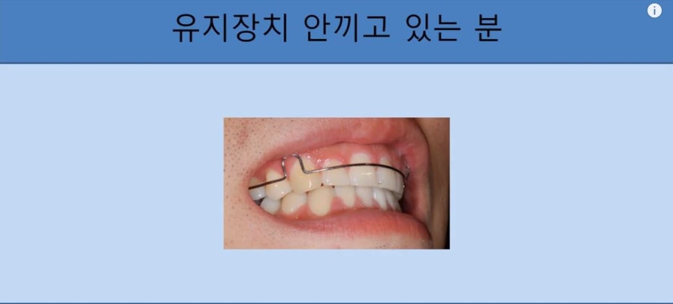 [치아교정] 치아교정 끝나고 요새 유지장치 안끼시는 분들 꼭 보시고 새출발하세요~~!! (돌출입교정, 덧니교정, 양악수술교정, 앞니교정한 분들 모두 해당됩니다) 관련 이미지 5