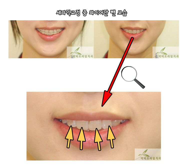 치아교정중 면접: 철사만 며칠 빼고~ 관련 이미지 2