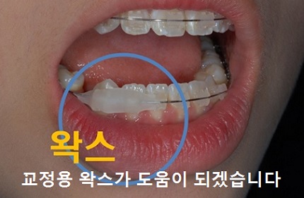 교정시작을 망설이게 하는 치아교정통증(2) 관련 이미지 8