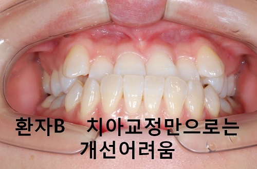 덧니와 주걱턱이 같이 있는 경우에 가장 효과적인 교정방법! 관련 이미지 12