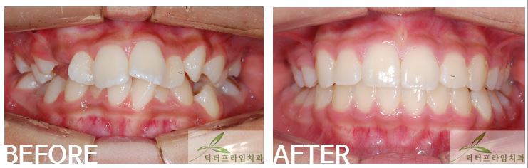 [치아교정후기] 고르지않은 덧니교정, 초등학생과 중학생은 치아교정후 블랙트라이앵글이 생기지 않습니다! 관련 이미지 1