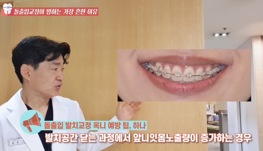 돌출입 교정치과 옥니 돌출입 치아 교정 왜 망할까? 관련 이미지 19