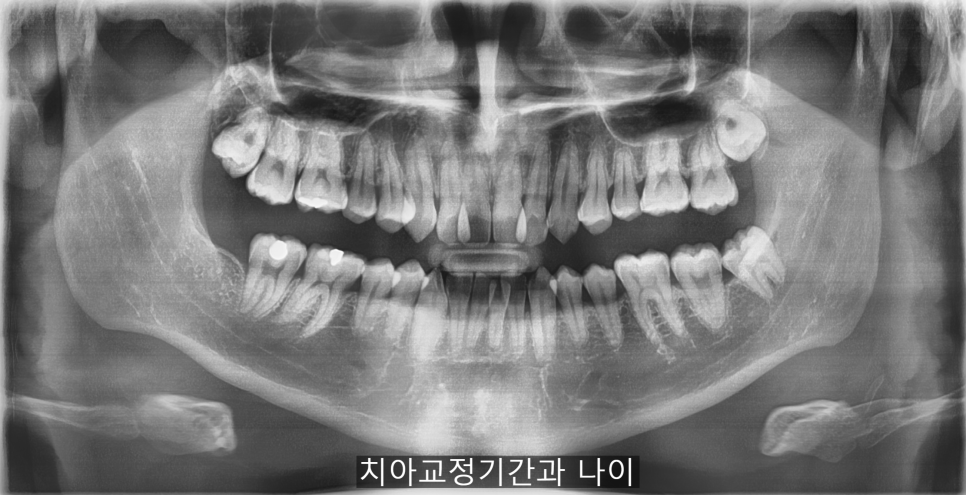 치아교정기간 짧아지는 방법 6가지! 관련 이미지 2