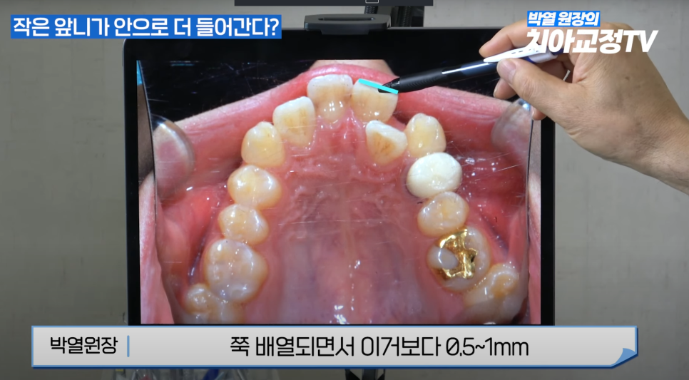 강남역 교정치과 :: 앞니 교정 시작 전에 꼭 알아야 할 한 가지 사실! 관련 이미지 9