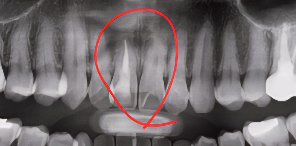 What Is Root Resorption? Changes in the Front Tooth Roots That Can Occur During Orthodontic Treatment image 3