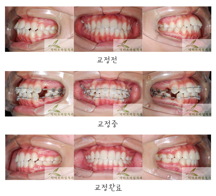 [돌출입치아교정후기] 돌출입클리피씨교정후기. 클리피씨교정기가 장점이 있긴 하지만 반드시 월등히 좋은 것은 아닙니다. 관련 이미지 1