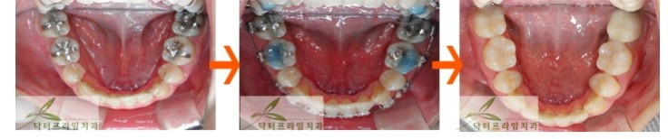 [치아교정후기] 앞니크라운 있는 경우의 치아교정전후 관련 이미지 5