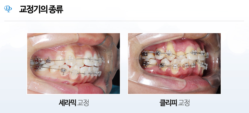 [교정기종류] 클리피씨교정기가 빠르고 통증도 없다? 관련 이미지 2