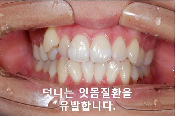 청소년, 덧니교정 안하면 이렇게 된다! 관련 이미지 8