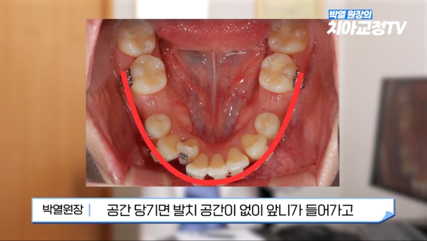교정 중 불편함, 알고 나면 안심됩니다 관련 이미지 4