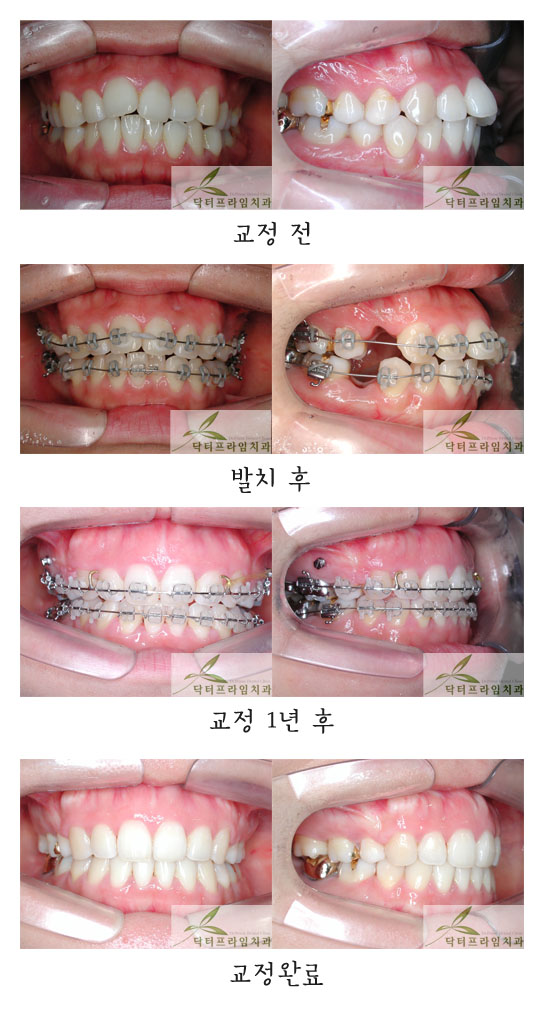 *[치아교정후기] 돌출입교정. 잇몸뼈돌출이라해도 교정만으로 좋은 결과가 나오는 경우가 많습니다!! 30대여성 심한 돌출입교정전후 관련 이미지 1