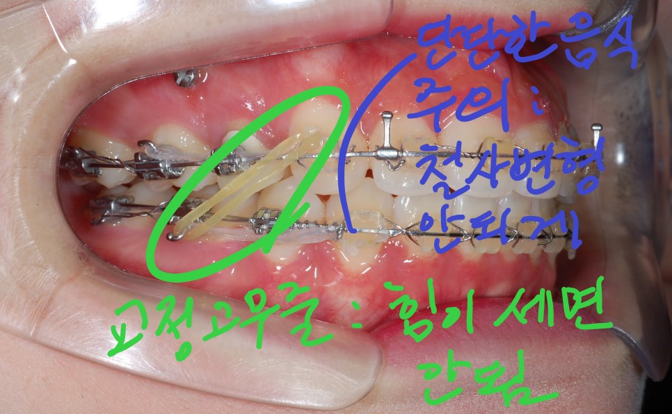 [치아교정] 교정고무줄 너무 세면 안돼요. 왠지 아세요? 치아교정과 교정고무줄!(교정고무줄사용자 필독사항도 링크됨) 관련 이미지 3