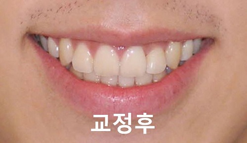 덧니교정과정, 4가지 요점만 알고 시작하세요! 관련 이미지 22