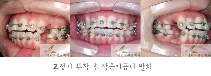 [치아교정후기] 30대 돌출입교정전후와 후기 관련 이미지 2