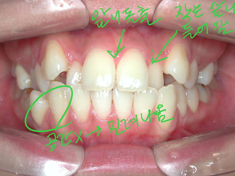 [치아교정] 20대여성 돌출입+덧니 발치교정후기(전후사진) 관련 이미지 1