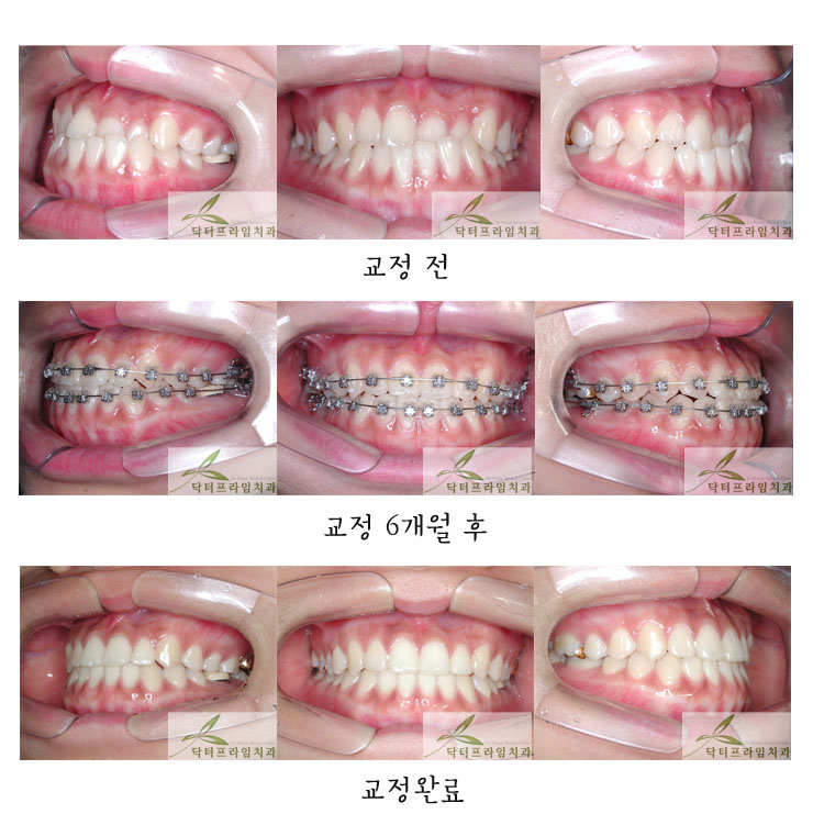 [치아교정후기] 반대교합 전후사진과 후기 관련 이미지 1